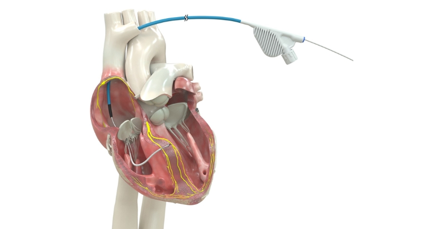 FDA Approves Medtronic’s OmniaSecure Defib Lead for LBB Placement